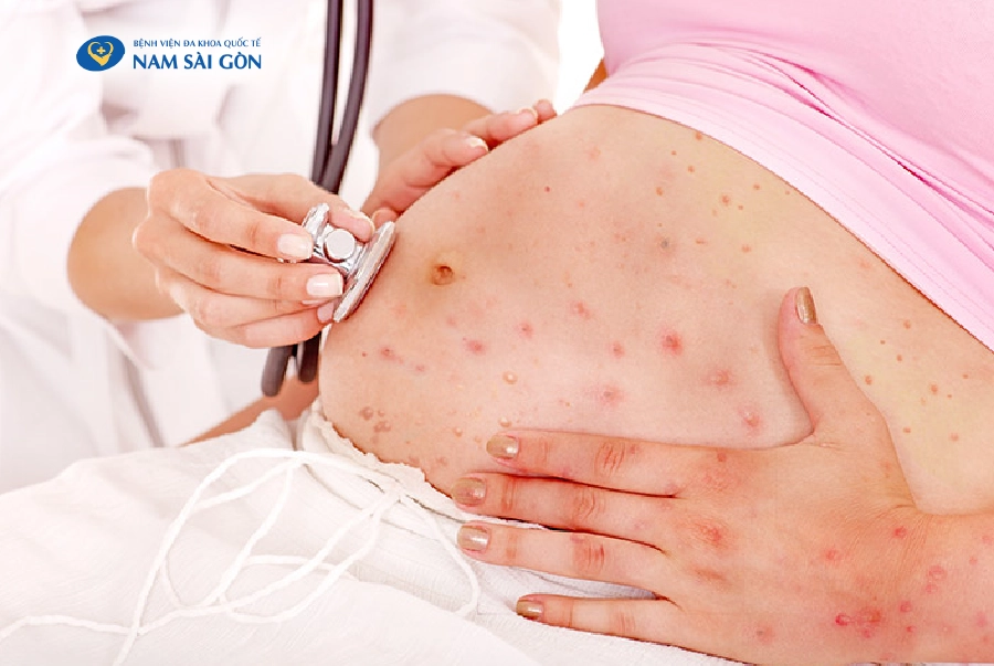 IS CHICKENPOX DANGEROUS DURING PREGNANCY?