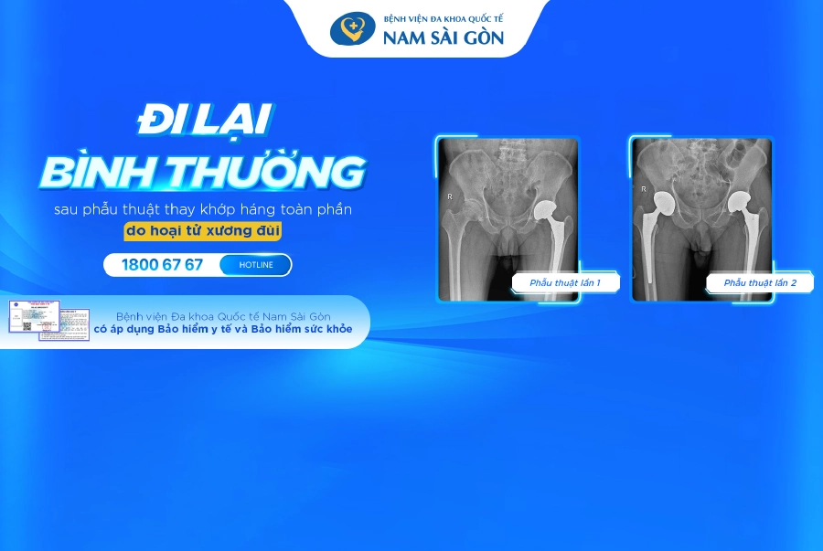 ĐI LẠI BÌNH THƯỜNG SAU PHẪU THUẬT THAY KHỚP HÁNG TOÀN PHẦN DO HOẠI TỬ CHỎM XƯƠNG ĐÙI