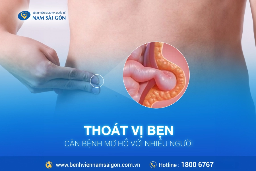 THOÁT VỊ BẸN VÀ NHỮNG ĐIỀU CẦN BIẾT