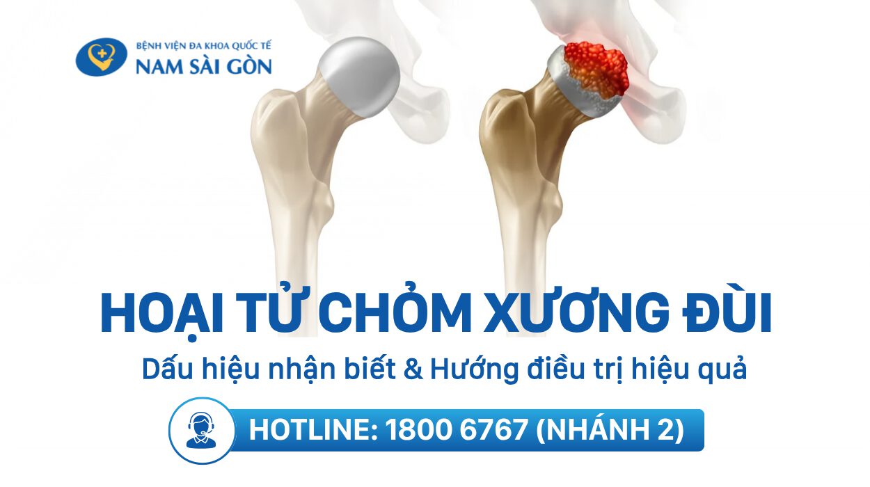 HOẠI TỬ CHỎM XƯƠNG ĐÙI – NGUYÊN NHÂN, DẤU HIỆU, CHUẨN ĐOÁN, ĐIỀU TRỊ