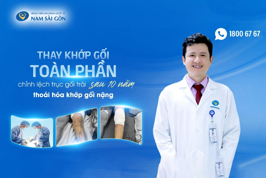 THAY KHỚP GỐI TRÁI TOÀN PHẦN CHỈNH LỆCH TRỤC SAU 10 NĂM THOÁI HÓA NẶNG