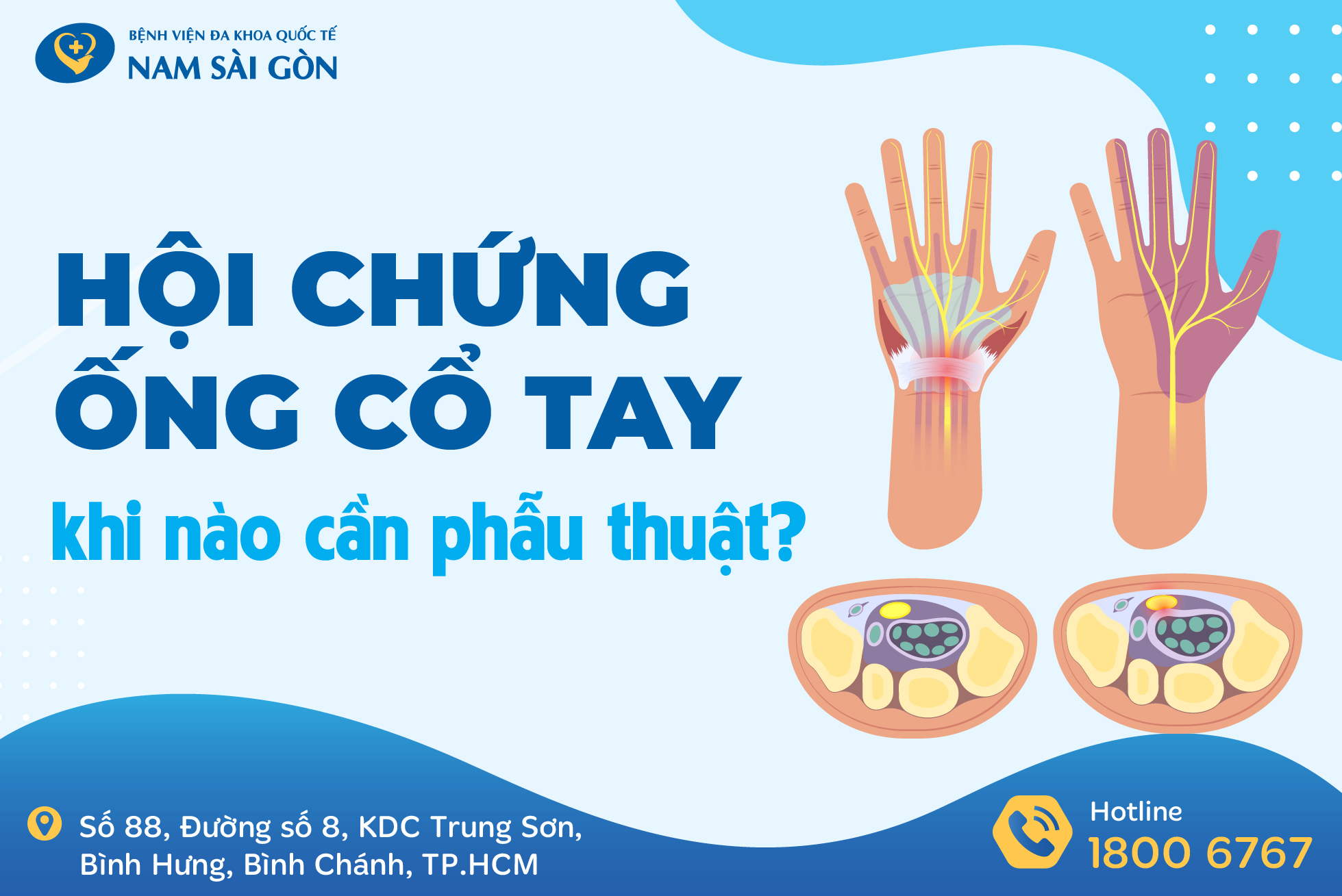 HỘI CHỨNG ỐNG CỔ TAY – NGUYÊN NHÂN, TRIỆU CHỨNG, ĐIỀU TRỊ & PHÒNG NGỪA