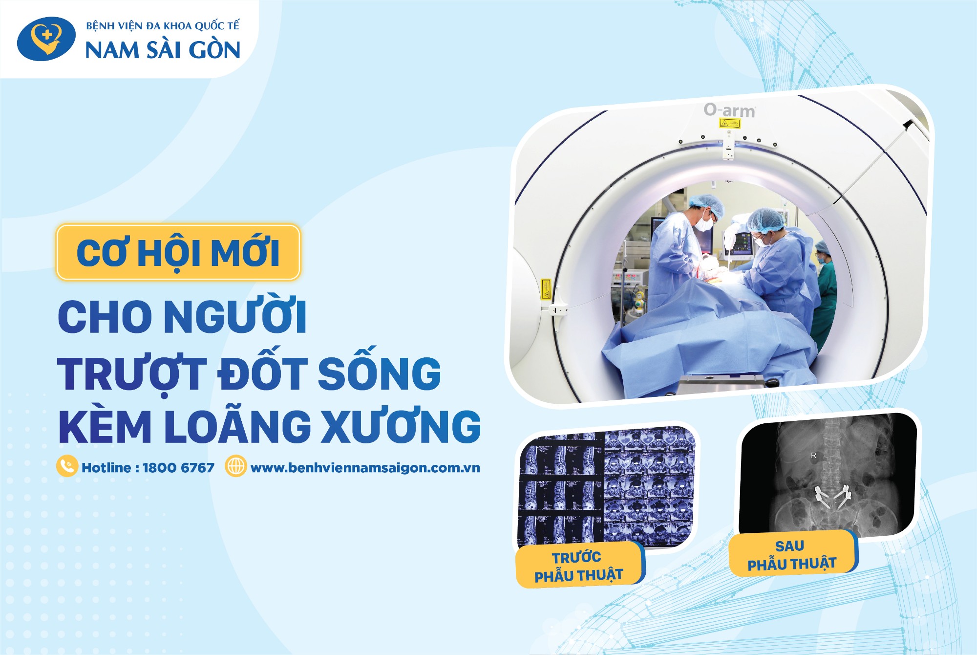 ỨNG DỤNG O-ARM TRONG PHẪU THUẬT BẮT VÍT QUA DA NẮN CHỈNH TRƯỢT ĐỐT SỐNG