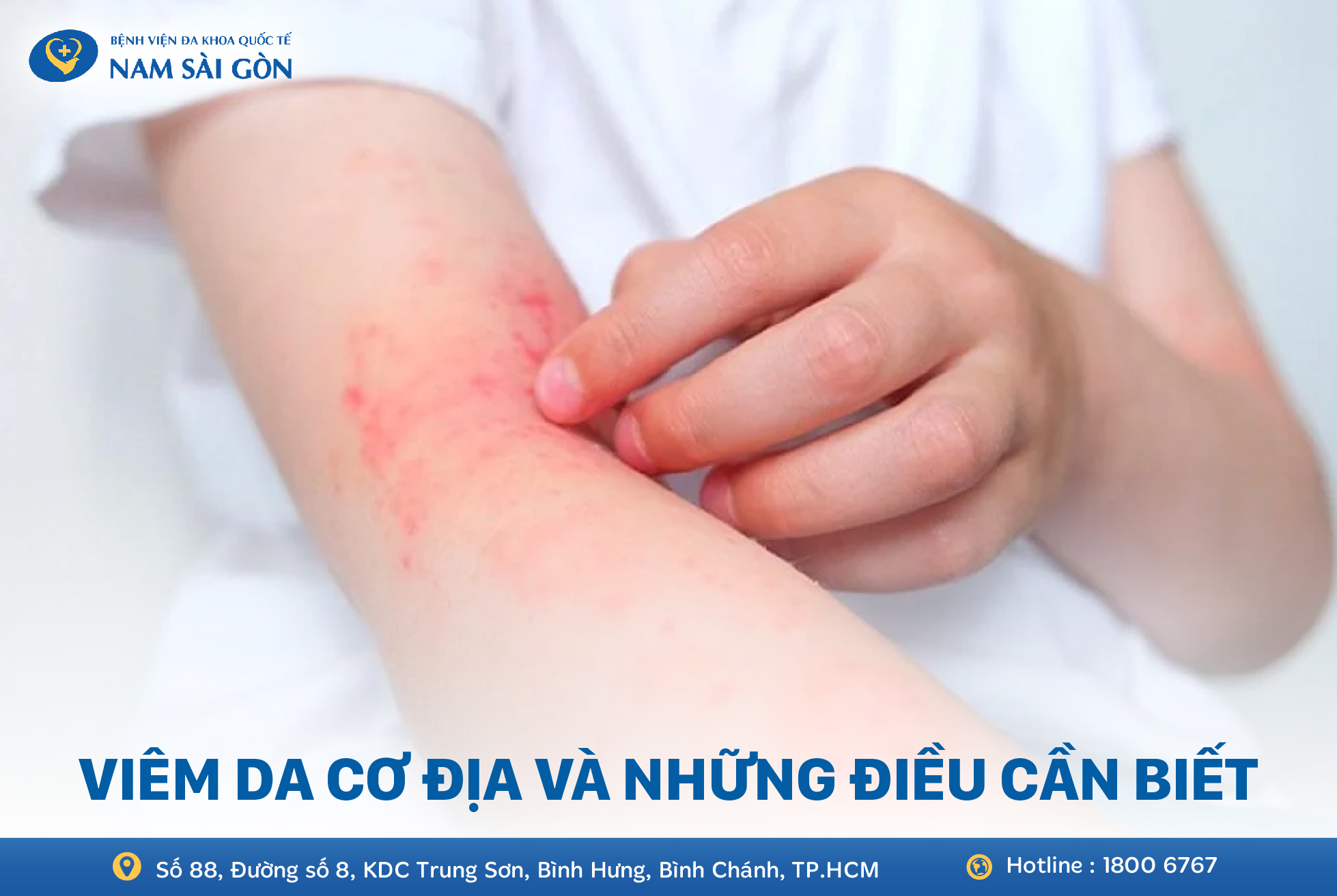 ATOPIC DERMATITIS – SYMPTOMS, CAUSES & TREATMENT